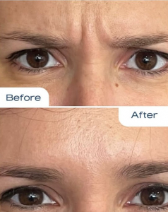 #Podcast 5 : Au-Delà des Rides : L'Art et la Science du Botox